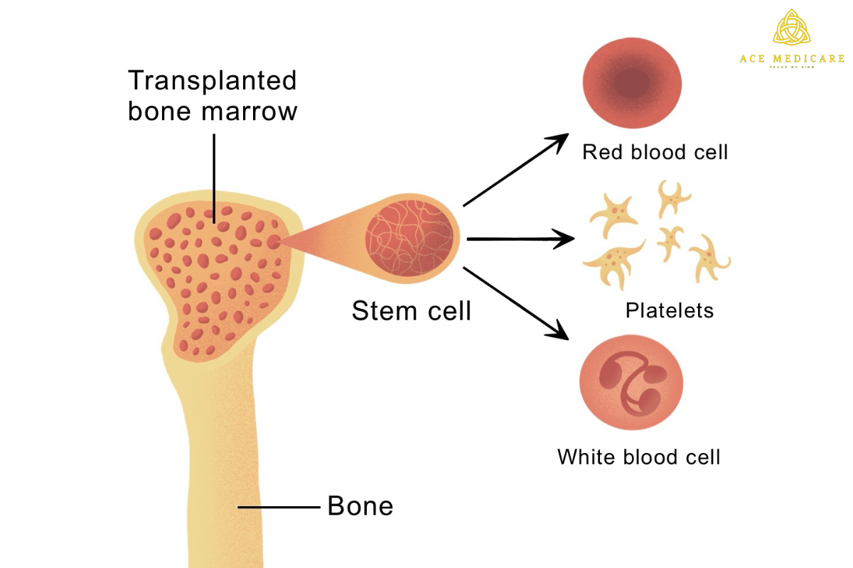 How to Prepare for a Bone Marrow Transplant: A Comprehensive Guide